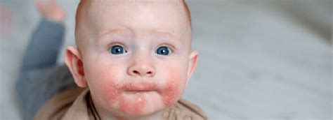 bebeklerde domates alerjisi belirtileri